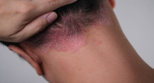 Psoriasi, Takeda annuncia risultati positivi per zasocitinib: la pillola sviluppata con supporto dell�AI supera Sotyktu in uno studio testa-a-testa